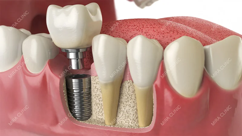 Implant Is Ready for a Crown